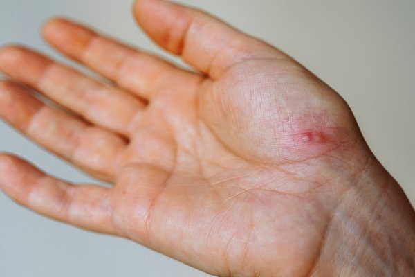 Éczema bulleux et dishydrose : reconnaître et traiter efficacement